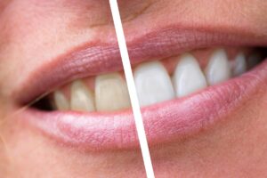 Denti prima e dopo sbiancamento: da una parte gialli e da una parte bianchi
