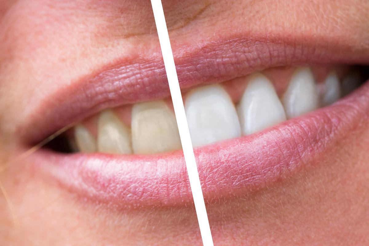 Denti prima e dopo sbiancamento: da una parte gialli e da una parte bianchi